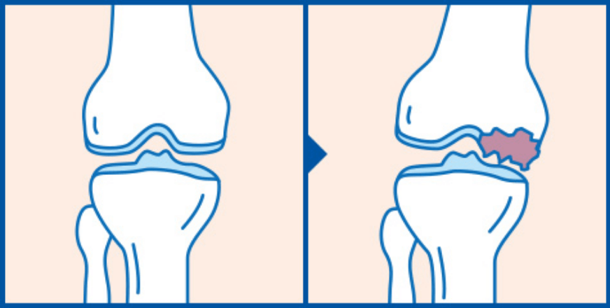 特発性膝関節骨壊死の図