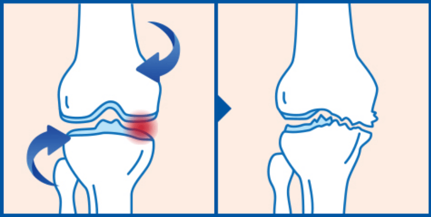 外傷性膝関節炎の図